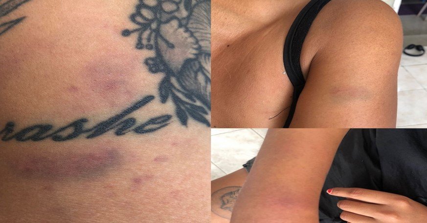 PAMELA VICTIMA DE GOLPES Y ABUSO DE AUTORIDAD POR PARTE DE LA POLICIA ESTATAL SSP PAMELA VICTIMA DE GOLPES Y ABUSO DE AUTORIDAD POR PARTE DE LA POLICIA ESTATAL SSP