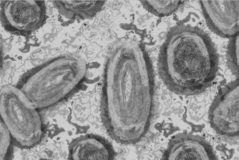 Quintana Roo suma tres caso de viruela del mono