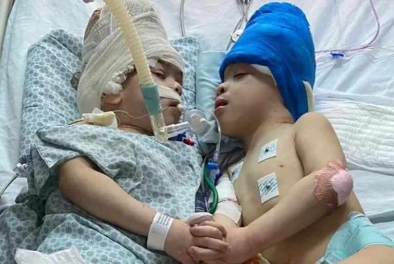 Separan a siameses unidos por la cabeza con ayuda de realidad virtual