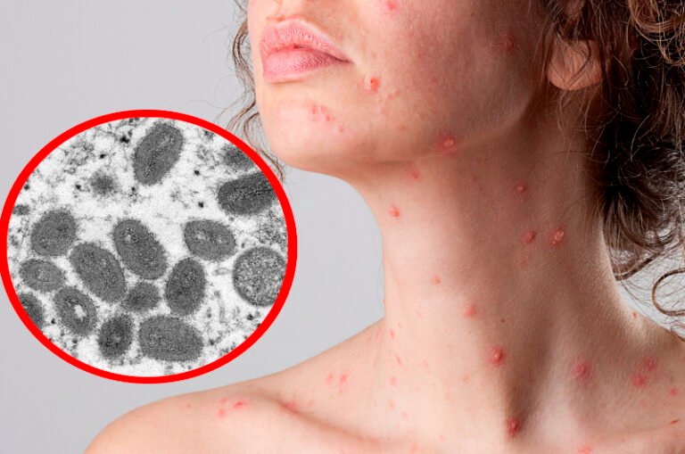 Yucatán registra seis nuevos casos de Viruela del Mono, van 24 personas contagiadas